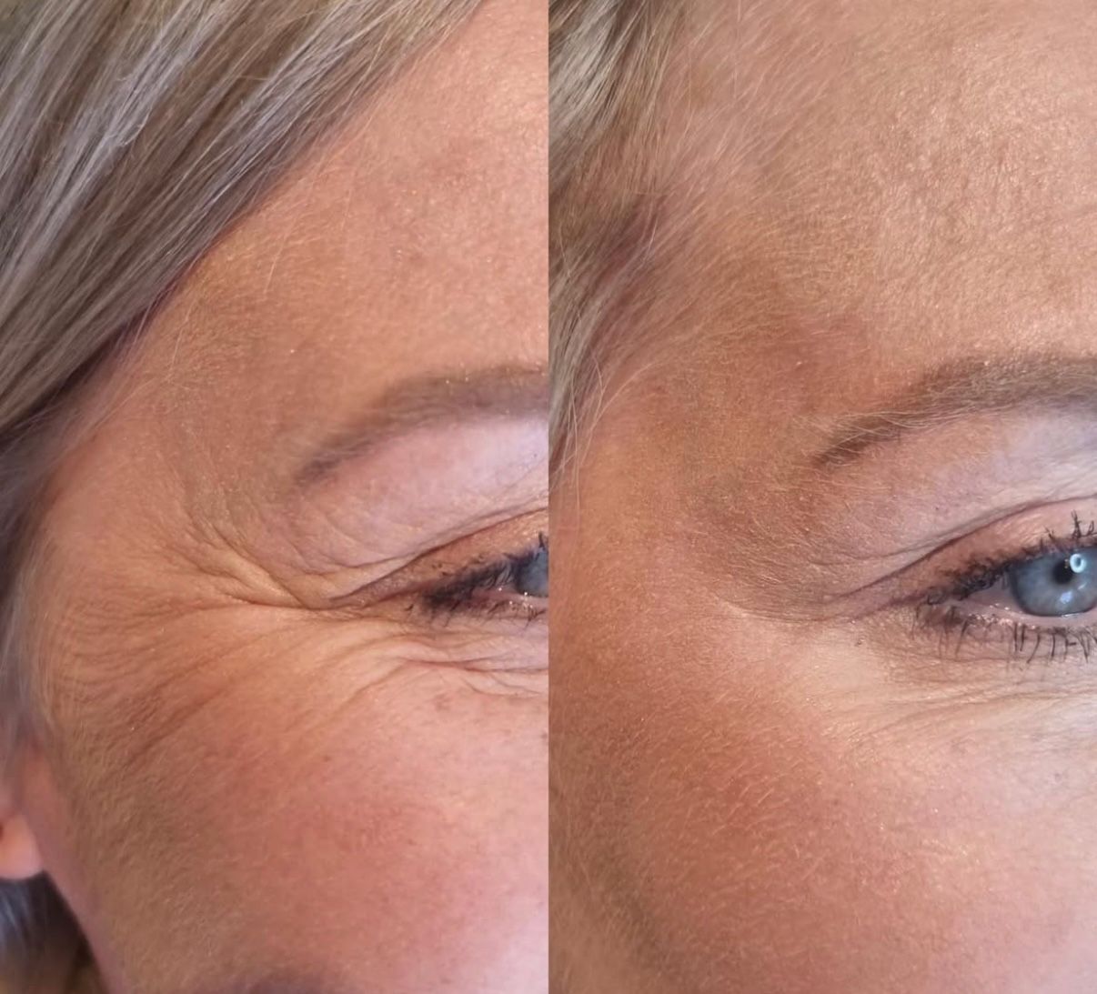 Anti-wrinkle, crow's feet around the eyes — softer, smoother skin