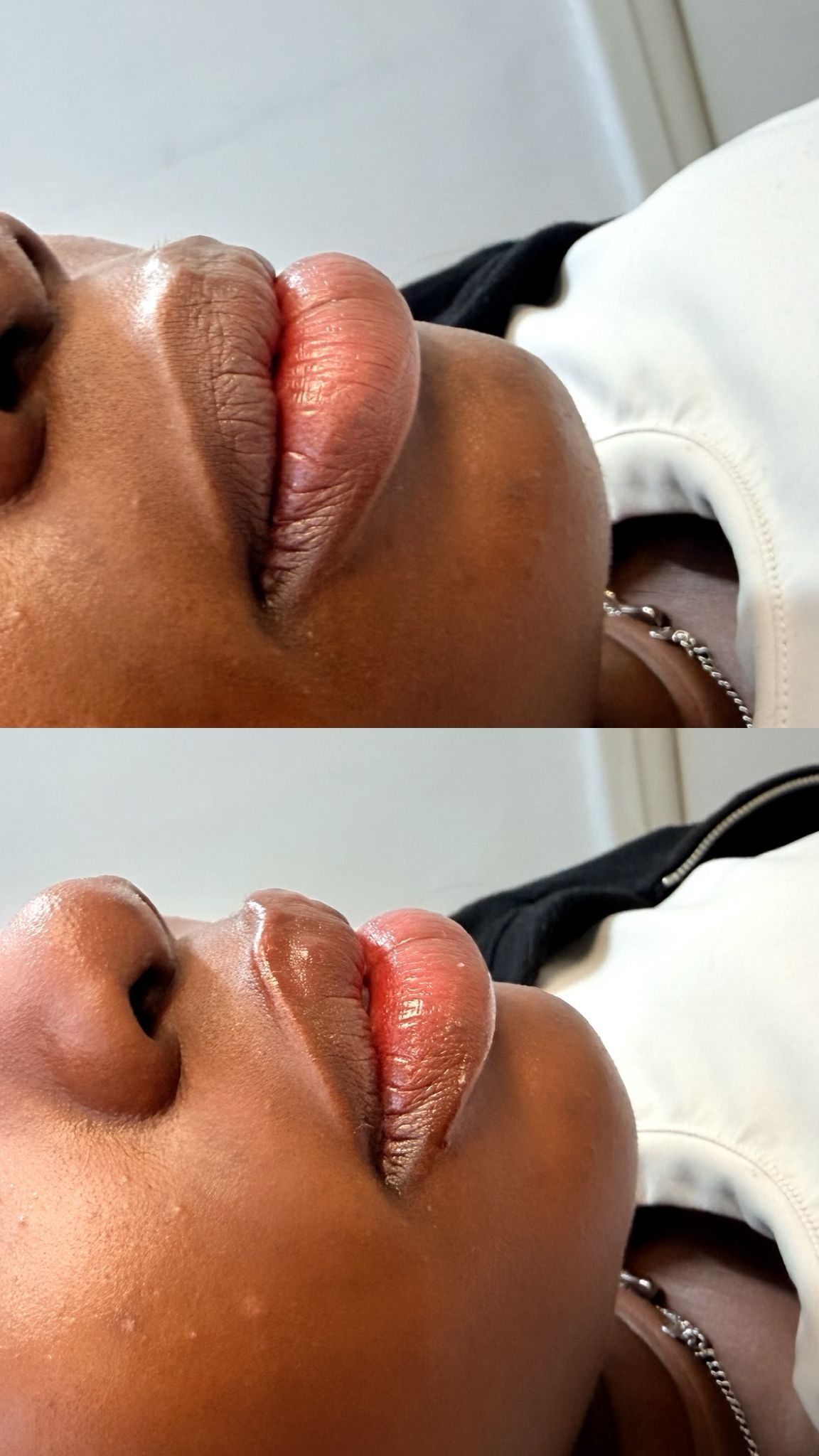 Cupid's bow lip filler — defined, sculpted shape