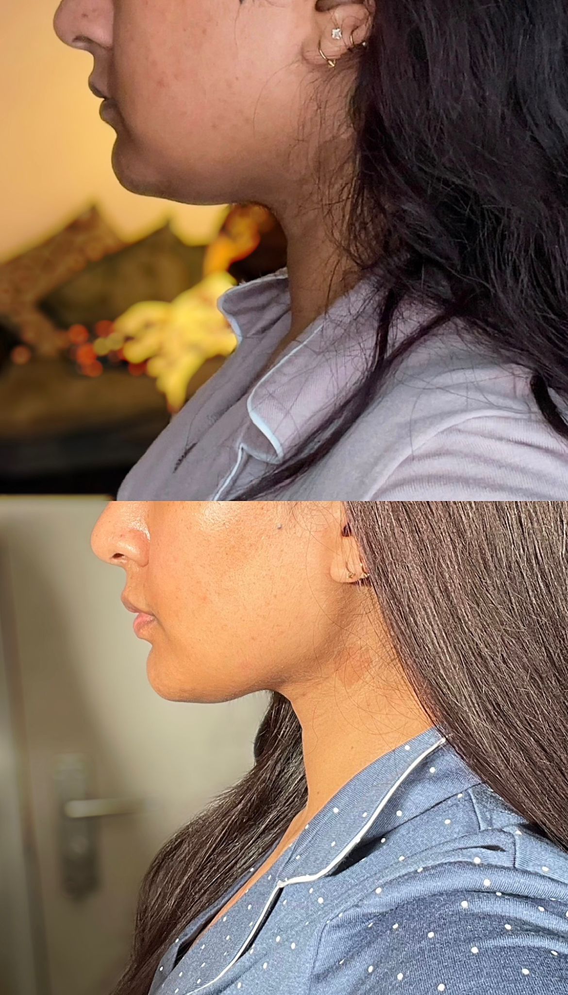 Fat dissolving — chin & jawline definition