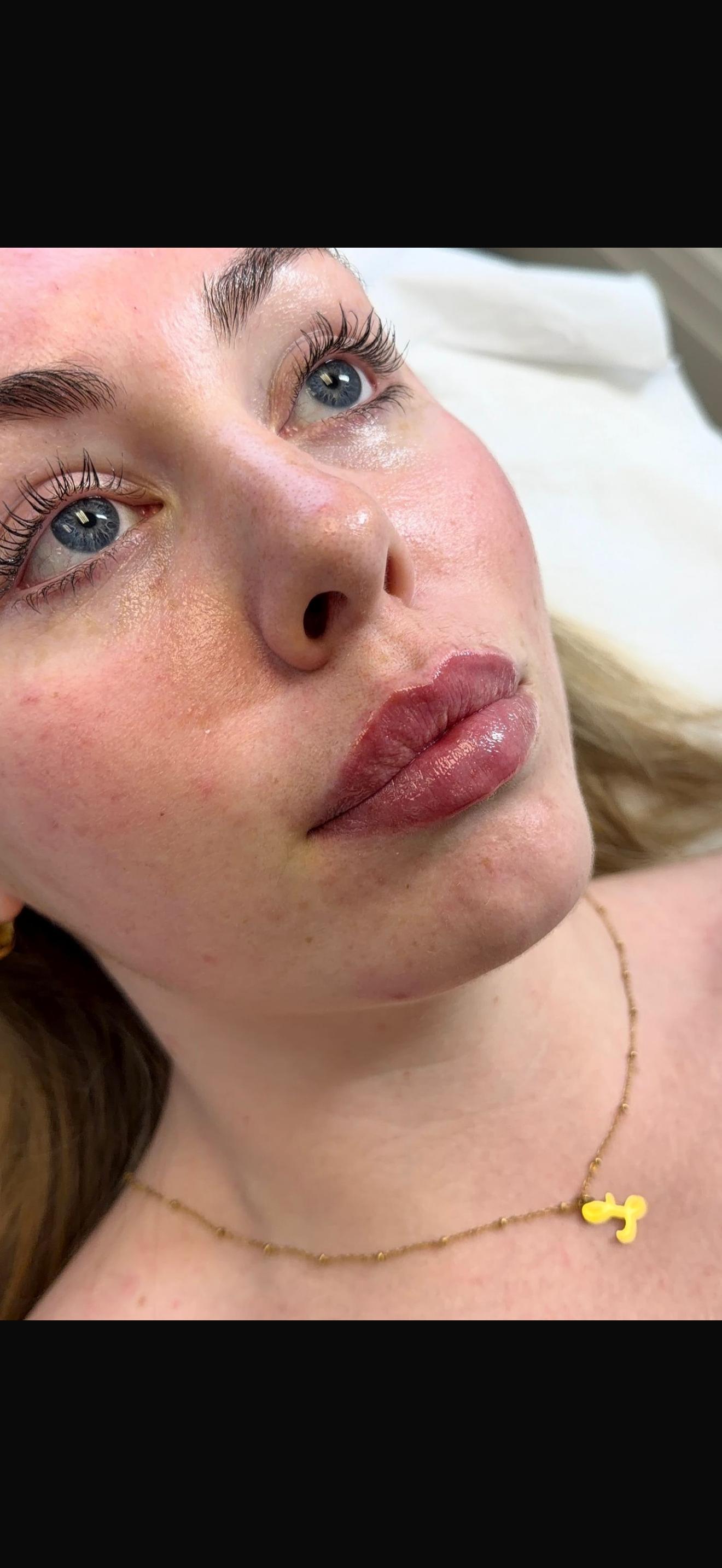 0.5ml lip filler — soft, balanced shape